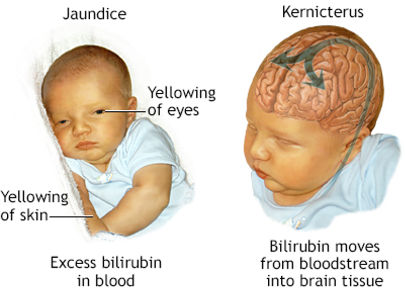 When Your Baby Turns Yellow The Real Factors Behind Jaundice